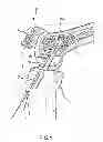 Fig. 02 - SOFT TISSUE GRAFT FIXATION