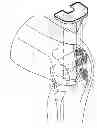 Fig. 01 - Method of designing orthopedic implants using in vivo data