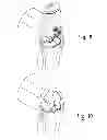 Fig. 08 - Method of designing orthopedic implants using in vivo data