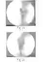 Fig. 22 - Method of designing orthopedic implants using in vivo data
