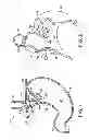 Fig. 02 - APPARATUS INCLUDING MULTIPLE INVAGINATORS FOR RESTORING A GASTROESOPHAGEAL FLAP VALVE AND METHOD