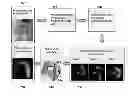 Fig. 01 - Method and system for patient-specific hemodynamic assessment of virtual stent implantation