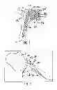 Fig. 02 - Method for optimization of joint arthroplasty component design