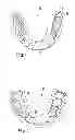 Fig. 02 - Dental splint made of two plastics with different degrees of hardness