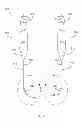 Fig. 07 - Bodily implants and methods for delivery and placement of bodily implants into a patients body