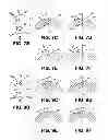 Fig. 06 - Method and apparatus for making improved surgical incisions in corrective eye surgery