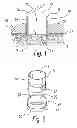 Fig. 02 - TREATMENT TIP INCISION TEMPLATE
