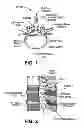 Fig. 02 - Multiple pathways for spinal nerve root decompression from a single access point
