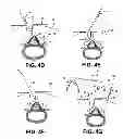 Fig. 07 - Multiple pathways for spinal nerve root decompression from a single access point