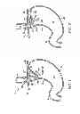 Fig. 02 - Apparatus and method for manipulating stomach tissue and treating gastroesophageal reflux disease