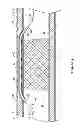 Fig. 06 - Subintimal recanalization with bio-absorbable stent