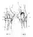Fig. 02 - Bone plate with two different sizes of discrete drill guides connected to the plate