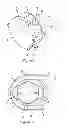 Fig. 02 - Prosthesis