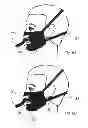 Fig. 07 - ALS treatment