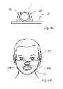 Fig. 08 - ALS treatment