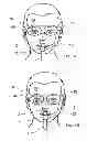 Fig. 09 - ALS treatment