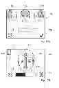 Fig. 22 - ALS treatment