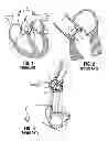 Fig. 02 - Knotless suture anchoring devices and tools for implants