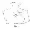Fig. 02 - LEAD ANCHORING SYSTEM WITH LIMITED MOVEMENT OF ANCHORING DEVICE ALONG LEAD