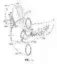 Fig. 09 - Anti-Leakage Prosthesis