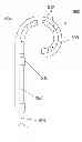 Fig. 01 - Ureteral stent drug delivery device, kit, and method