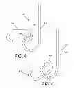Fig. 03 - Ureteral stent drug delivery device, kit, and method