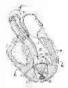 Fig. 01 - System for improving cardiac function by sealing a partitioning membrane within a ventricle