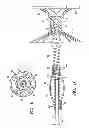 Fig. 06 - System for improving cardiac function by sealing a partitioning membrane within a ventricle