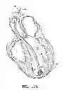 Fig. 07 - System for improving cardiac function by sealing a partitioning membrane within a ventricle