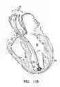 Fig. 08 - System for improving cardiac function by sealing a partitioning membrane within a ventricle