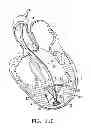 Fig. 09 - System for improving cardiac function by sealing a partitioning membrane within a ventricle