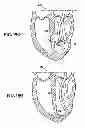 Fig. 18 - System for improving cardiac function by sealing a partitioning membrane within a ventricle