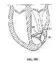 Fig. 22 - System for improving cardiac function by sealing a partitioning membrane within a ventricle