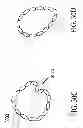 Fig. 33 - System for improving cardiac function by sealing a partitioning membrane within a ventricle