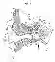 Fig. 02 - IMPLANTATION OF A HEARING PROSTHESIS