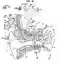 Fig. 07 - IMPLANTATION OF A HEARING PROSTHESIS