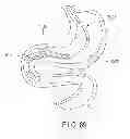 Fig. 48 - Rotate-to-advance catheterization system