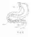 Fig. 49 - Rotate-to-advance catheterization system