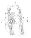 Fig. 53 - Rotate-to-advance catheterization system