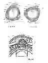Fig. 74 - Rotate-to-advance catheterization system