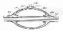 Fig. 01 - Nested balloon catheter for localized drug delivery