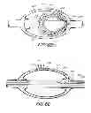 Fig. 06 - Nested balloon catheter for localized drug delivery