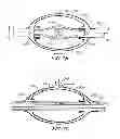 Fig. 08 - Nested balloon catheter for localized drug delivery