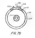 Fig. 09 - Nested balloon catheter for localized drug delivery