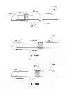 Fig. 06 - PASSIVE PRESSURE SENSOR FOR IMPLANTABLE LEAD