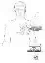 Fig. 01 - System and method for discriminating hypervolemia, hypervolemia and euvolemia using an implantable medical device