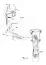 Fig. 03 - Dynamic exoskeletal orthosis