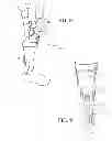 Fig. 06 - Dynamic exoskeletal orthosis