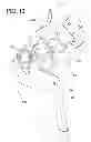 Fig. 09 - Dynamic exoskeletal orthosis