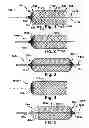 Fig. 02 - Method and apparatus for increasing blood flow through an obstructed blood vessel